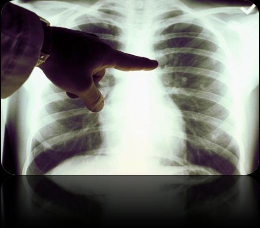 Utilidad de la TC con baja dosis La detección del cáncer de pulmón con la tomografía computarizada de baja dosis puede reducir la mortalidad global. Dres. : Linda L.