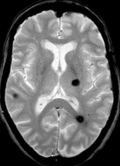 cavernomatosis cerebral.