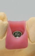 Importante: El pilar debe estar correctamente colocado en el octógono del implante antes de apretar el tornillo mano.