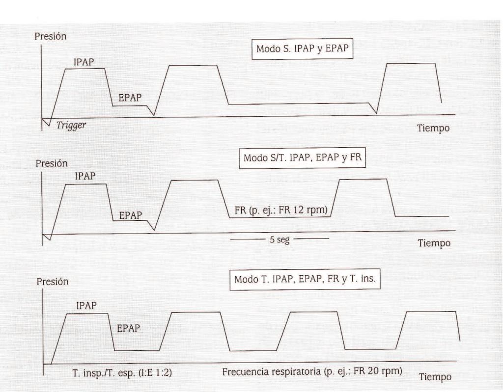 Ciclado Tipos de VMNI Ventilación con presión negativa externa Ventilación con presión positiva: Ventilación controlada por
