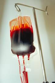 Transfusion y monitoreo de la sobrecarga de hierro en talasemia 1 unidad de sangre contiene 200 mg de hierro Un adulto con talasemia de 60 kg que recibe 45 unidades de sangre/ año tiene una entrada