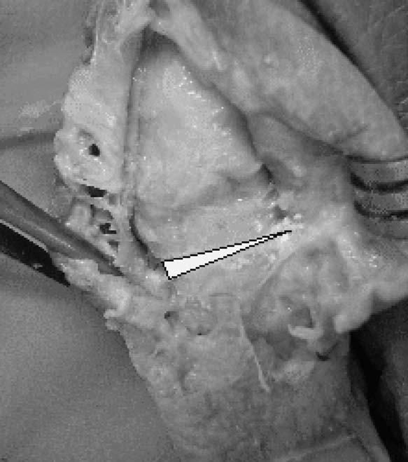 1. INTRODUCCIÓN La osteotomía de la base de la falange proximal del primer dedo fue descrita por O. F. Akin en 1925 (1,5).