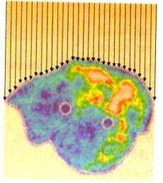 Diferencias conceptuales entre la Radioterapia y la Quimioterapia La RT: Distribución de dosis Homogénea.
