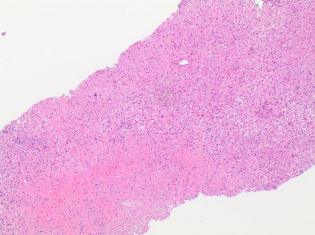 La imagen muestra una necrosis hepática submasiva con núcleos eosinófilos en muchos de los hepatocitos preservados.