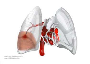 Flebitis Granulomas pulmonares