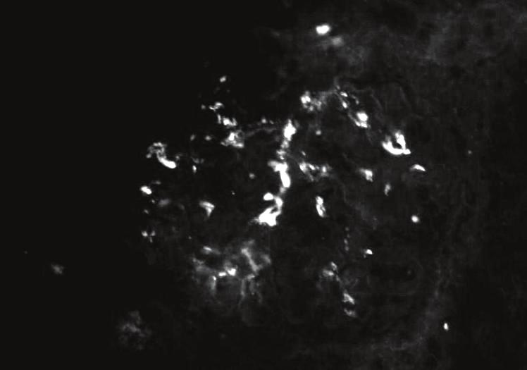 células mesangiales/área de mesangio M1 Ausencia de esclerosis Esclerosis (no requiere la totalidad del glomérulo) Ausencia de células dentro de la luz capilar glomerular Presencia de células dentro