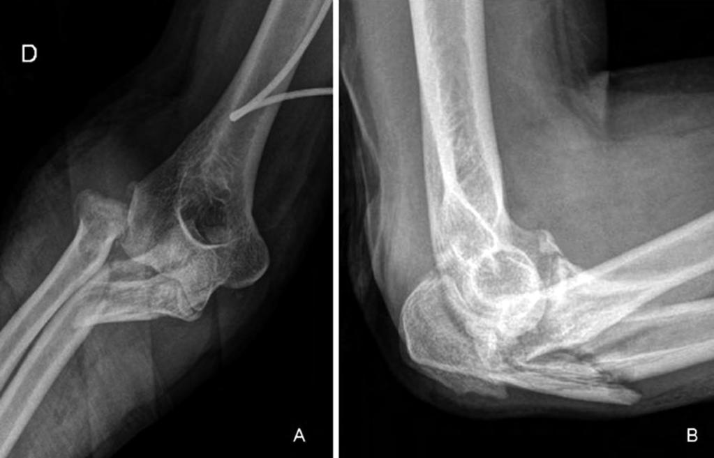 Artroplastia total de codo asociada a un aloinjerto osteoarticular de cúbito proximal tras fracaso de osteosíntesis de una fractura-luxación de Monteggia Introducción La artroplastia total de codo