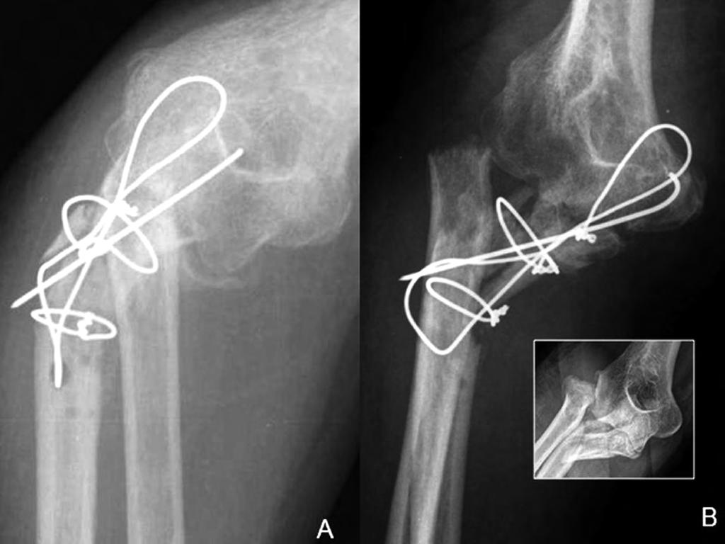 I. Proubasta Renart e t a l. Figura 2. Estudio radiográfico del codo del paciente. A) proyección anteroposterior. B) proyección oblicua.