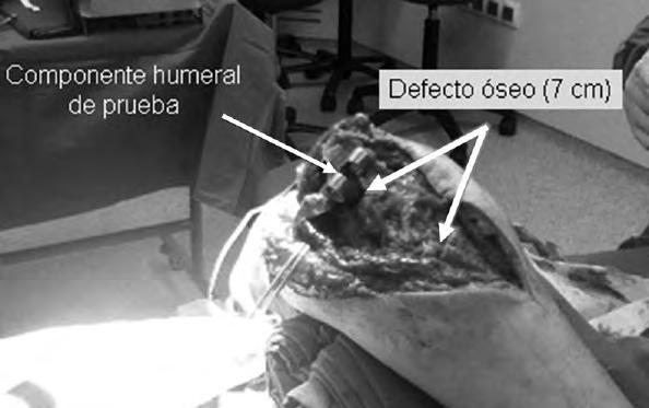Artroplastia total de codo asociada a un aloinjerto osteoarticular de cúbito proximal tras fracaso de osteosíntesis de una fractura-luxación de Monteggia Figura 3.