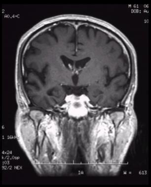 Enfermedad de Alzheimer. Cambios longitudinales en el tamaño del cerebro son asociados a pérdidas progresivas de habilidades cognitivas.