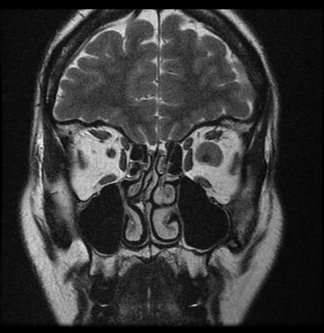 Tumores de la vaina nerviosa El meningioma deriva de la aracnoides que recubre el nervio óptico y constituyen el segundo tumor más