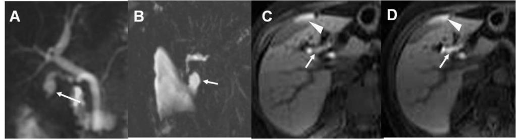 conducto cístico (flecha en A) y un cálculo obstructivo en el colédoco (flecha en B), y (cabeza de flecha en C) en un paciente con ictericia tres meses después de la colecistectomía Trauma
