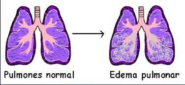 EAP El edema agudo de pulmón se define como el cuadro clínico