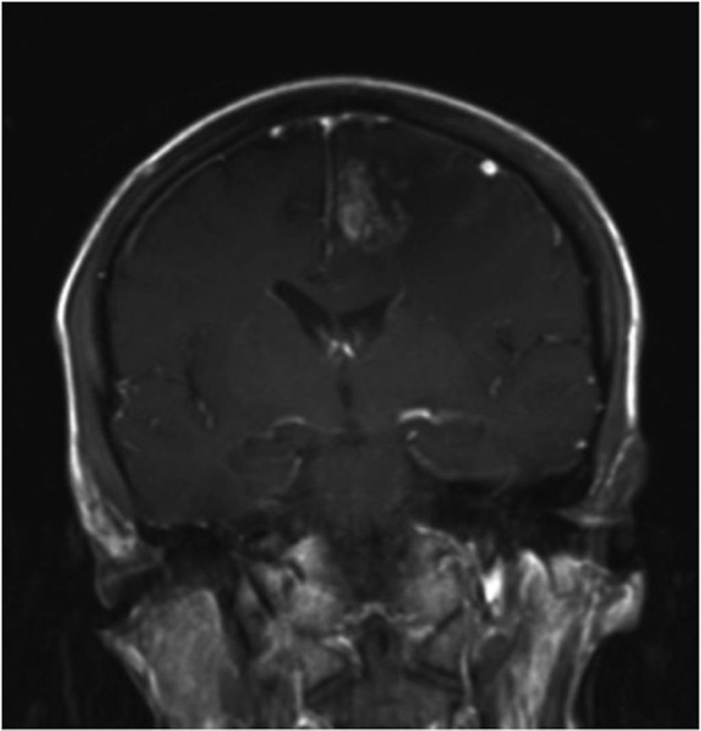 Fig. 8: Caso 2: Mujer de 37 años. MAV frontal izquierda tratada con múltiples embolizaciones y una sesión de RCE.