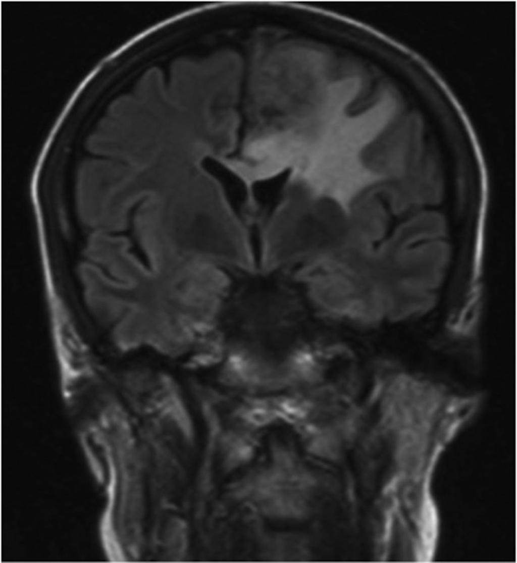Fig. 7: Caso 2: Mujer de 37 años. MAV frontal izquierda tratada con múltiples embolizaciones y una sesión de RCE.