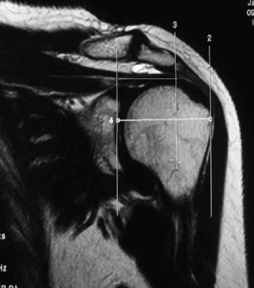 Figura Nº 4 b Índice Acromial: 0.73. REFERENCIAS 1. Hirano M, Ide J, Takagi K. Acromial shapes and extension of rotator cuff tears: Magnetic resonance imaging evaluation.
