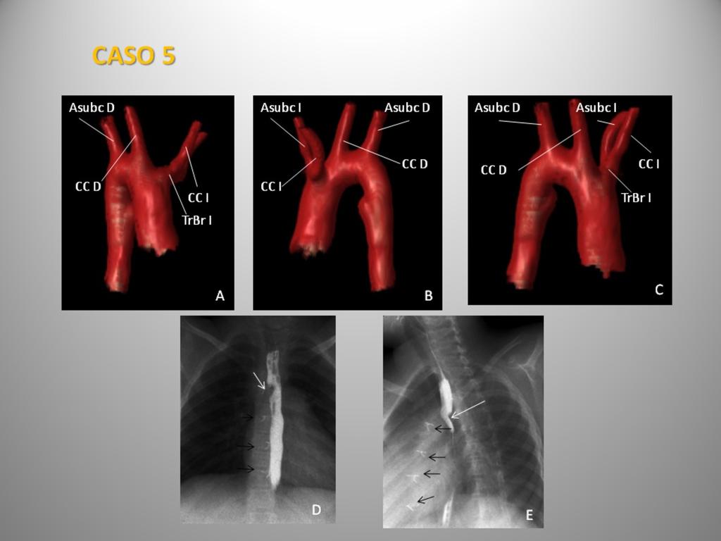 Fig. 6: Caso 5. Paciente de dos años intervenida de doble arco aórtico. A, B y C.
