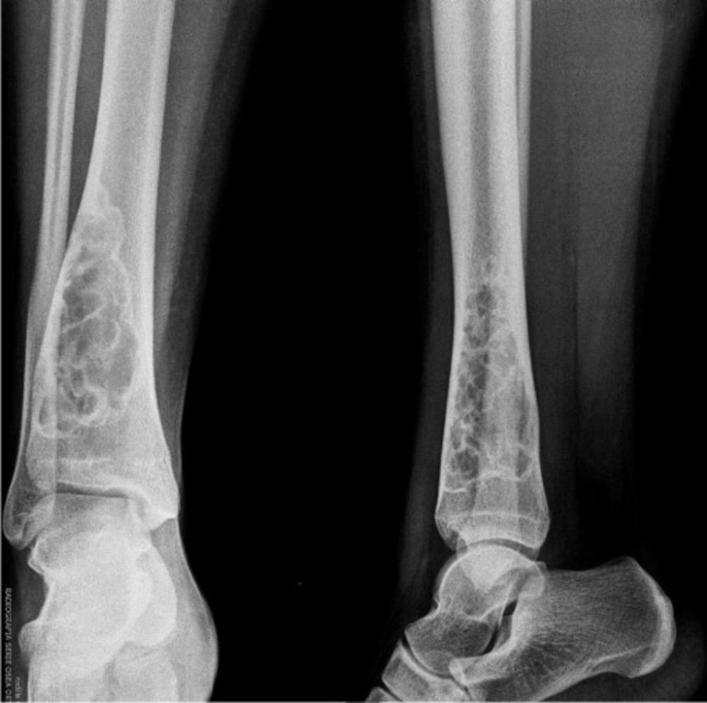 Fig. 28: DEFECTO FIBROSO CORTICAL NIÑA 13A.: Metáfisis femur presenta lesión radiolúcida, márgenes esclerosos, insufla ligeramente cortical. Fig.