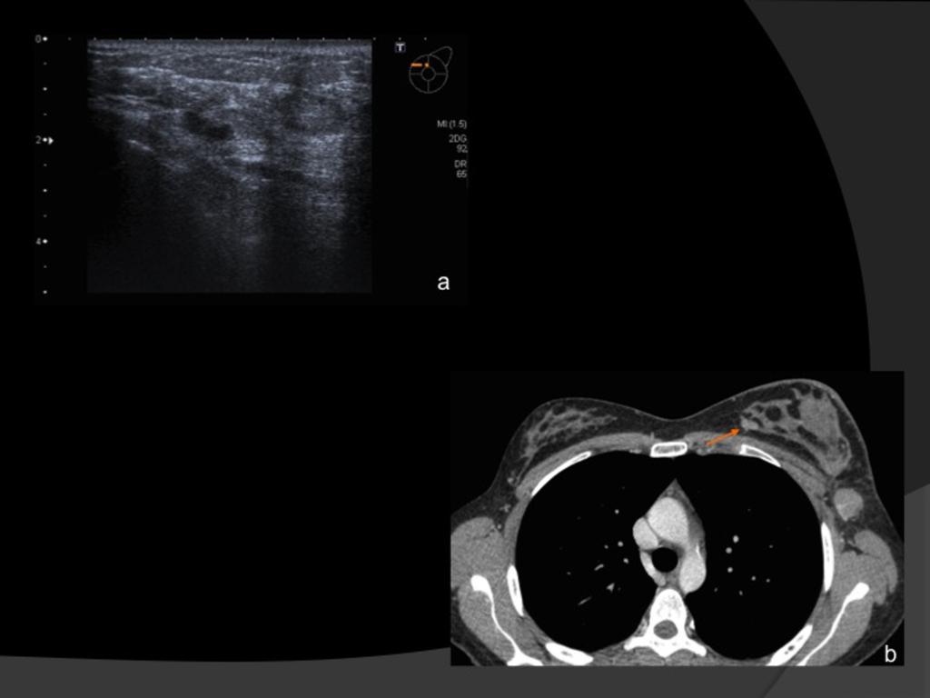 Fig. 2: Mujer de 33 años con adenopatias patológicas en axila izquierda, aumento de tamaño y edema de mama ipsilateral. No se identifican lesiones mamarias en primera ecografía.