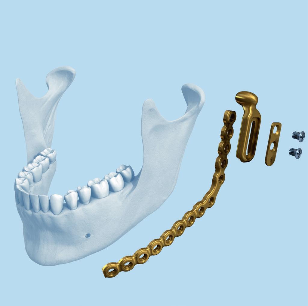 Para el moldeado de la placa y la resección mandibular, consulte la técnica quirúrgica correspondiente MatrixMANDIBLE (DSEM/ CMF/0814/0025) o la técnica quirúrgica UniLOCK Compact 2.