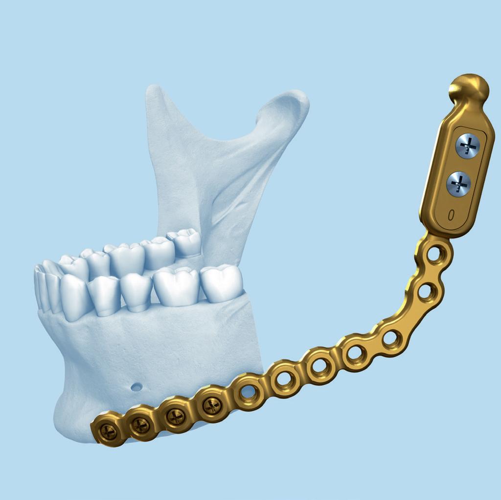 Antes de proceder a fijar la placa, compruebe que el paciente esté en fijación maxilomandibular provisional.