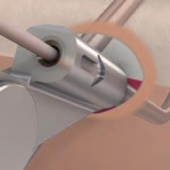 Procedimiento quirúrgico 3 Inserción del tubo para pasar cable Instrumento 03.221.