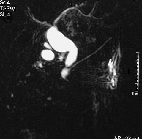 Fig. 3. Imagen de resonancia magnética de quiste de colédoco tipo V (enfermedad de Caroli) localizado en el lóbulo hepático izquierdo. Fig. 2.