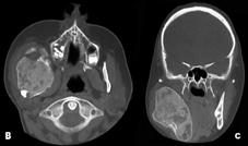 En los casos que está comprometida la base de cráneo se completa el estudio con tomografía de órbita y reconstrucción 3D.