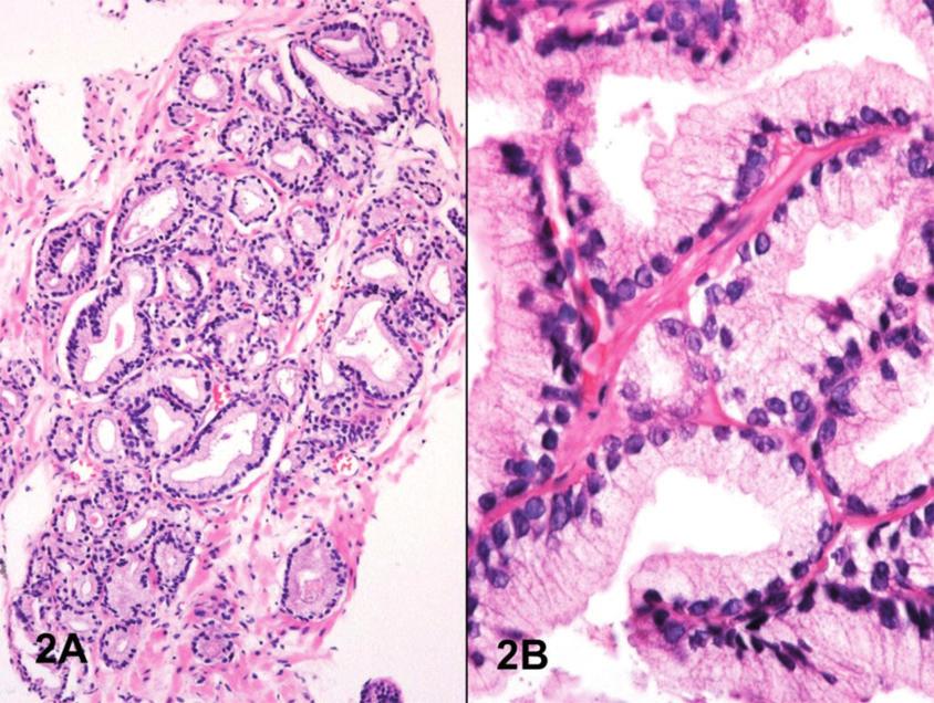 Arista-Nasr J y col. Segunda opinión en biopsia prostática Figure 2. A) Carcinoma con patrón de la zona de transición.