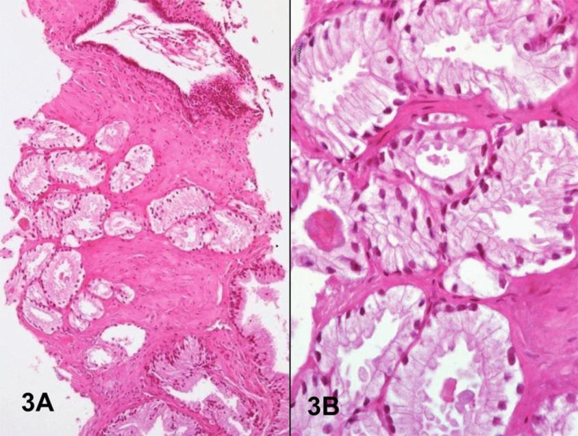 B) Las células de revestimiento muestran núcleos hipercromáticos, nucleomegalia y nucléolos aparentes que apoyan el diagnóstico de carcinoma.