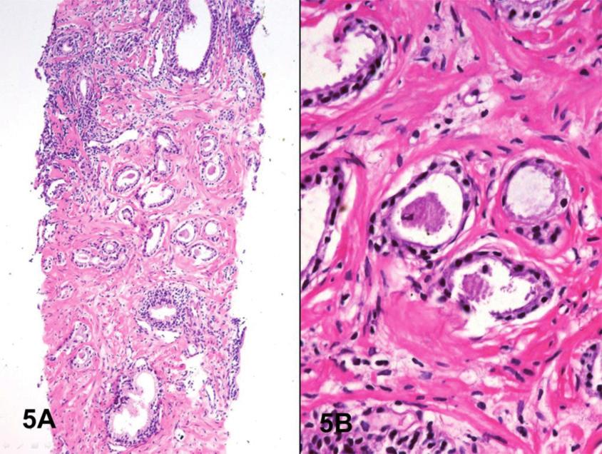 Arista-Nasr J y col. Segunda opinión en biopsia prostática Figure 5. A) Carcinoma atrófico. Las glándulas muestran escaso citoplasma y se disponen irregularmente.
