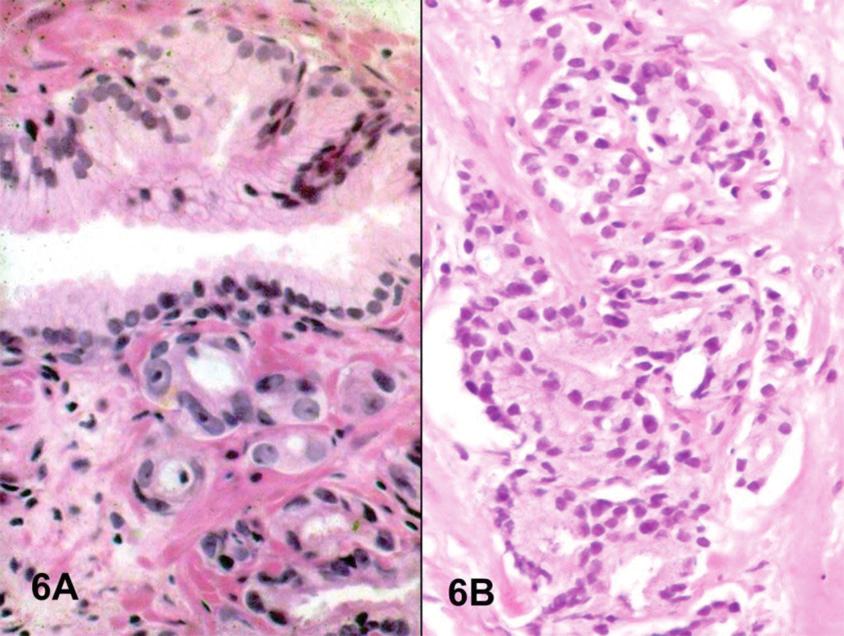 En el estudio inmunohistoquímico se demostró ausencia de células basales. aparentes y varios de los criterios diagnósticos mayores de carcinoma no están presentes (Figura 6B).