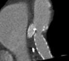coronariano Hemodinámicamente significativas o no Anomalías del curso Puente miocárdico Duplicación de arterias Anomalías de la terminación Fístula coronaria Eur