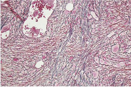 Mielofibrosis Grado 2 de MF que muestra un increment difuso y denso en las fibras de reticulina con intersecciones