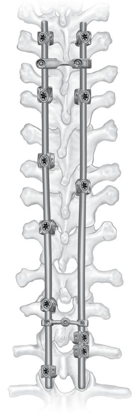 28 CD HORIZON LEGACY Spinal System Deformidad Técnica quirúrgica Colocación del conector transversal / cierre PASO 12 Después de realizar el ajuste final de los tornillos de bloqueo es obligatorio