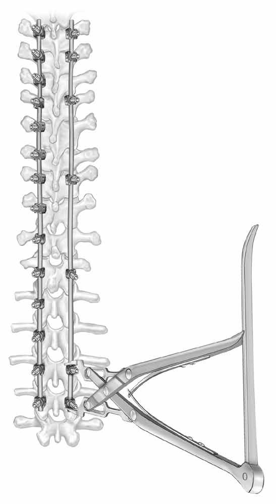 40 CD HORIZON LEGACY Spinal System Deformidad Técnica quirúrgica CD HORIZON LEGACY Spinal System Deformidad Técnica quirúrgica 41 Corrección de la deformidad continuación PASO 7 Ajuste final /