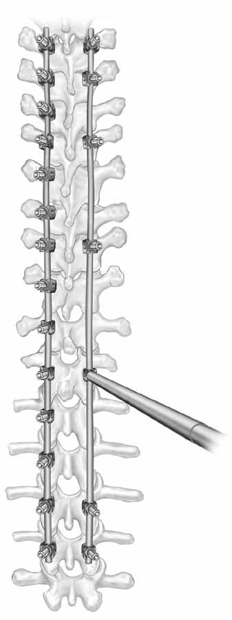 se ejercen fuerzas de compresión convexas en los segmentos mediante el compresor paralelo para colocar en posición horizontal la vértebra más caudal instrumentada y se comprime ligeramente la