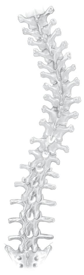 CD HORIZON LEGACY Spinal System Deformidad Técnica quirúrgica 11 Estrategia quirúrgica PASO 1 En toda cirugía raquídea es necesario realizar un estudio preoperatorio para definir un esquema de la