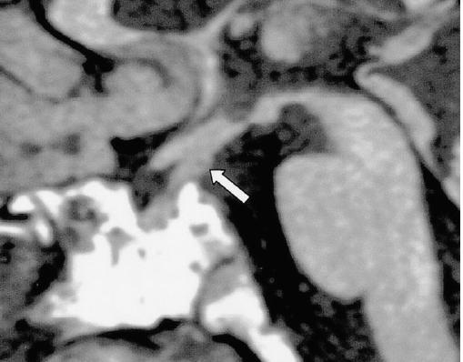 Tomado de Shin y colaboradores [78]. Figura 6. Resonancia magnética, imagen T1 sagital. Histiocitosis de células de Langerhans.