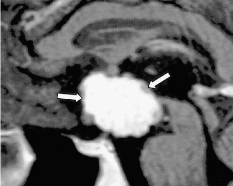 Resonancia magnética contrastada, imagen T1 sagital. Craneofaringioma. Se observa una masa sólida correspondiente al tumor (flechas), ubicado en el área supraselar y en el hipotálamo.