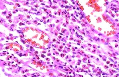 Los eosinófilos caracterizan la inflamación en rinitis
