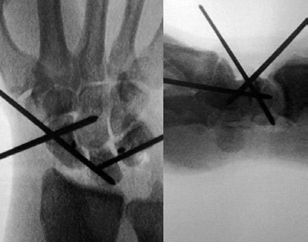 I. Auñón Martín et al. Figura 1: Tratamiento de lesión perilunar con reducción abierta y fijación interna más reparación capsulo. Figura 2: Reparación del espacio escafosemilunar en lesión perilunar.