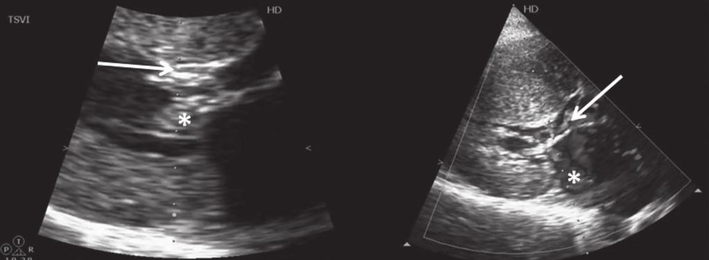 Paciente con miocardiopatía hipertrófica septal asimétrica obstructiva secundaria a movimiento anterior sistólico de la válvula mitral, acompañado de insuficiencia mitral.