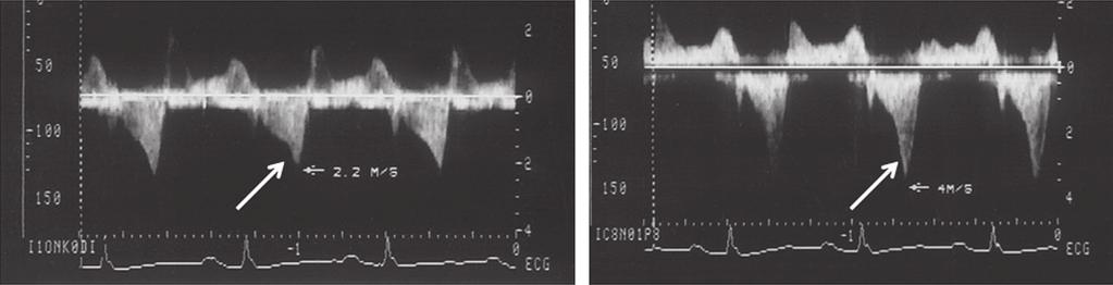 12 Módulo 8 Fascículo Nº 1 2012 Fig. 8. Registro Doppler de onda continua del gradiente de obstrucción dinámica en el tracto de salida del ventrículo izquierdo.