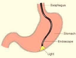 La sonda de gastrostomía endoscópica percutánea (PEG) La colocación de una sonda de gastrostomía endoscópica percutánea (PEG, por sus siglas en inglés) se realiza generalmente, aquí en Rady Children