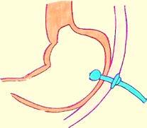La luz brilla por la pared del estómago y permite que el médico coloque con precisión un pequeño orificio en la pared del estómago.