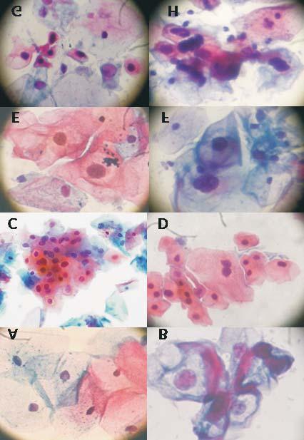 166 Méndez Toro y col. Fig. 2. Citología de la infección por VPH en cuello uterino. A. células escamosas normales (40X); B. coilocito (40X); C disqueratocito (10X); D binucleación (10X); E.