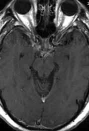 Los quistes lires en los ventrículos pueden cusr el síndrome de Brun, crcterizdo por ostrucción intermitente de l circulción del LCR con episodios recurrentes de cefle, vértigo, txi y síncope (4).