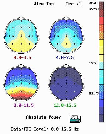Potencias de ritmos cerebrales Distribución normal Ritmos: (Niedermayer)