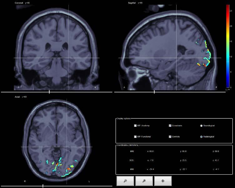 Puede el EEG en reposo reflejar el funcionamiento cerebral